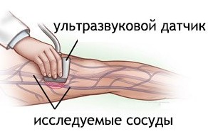 УЗД судин нижніх кінцівок